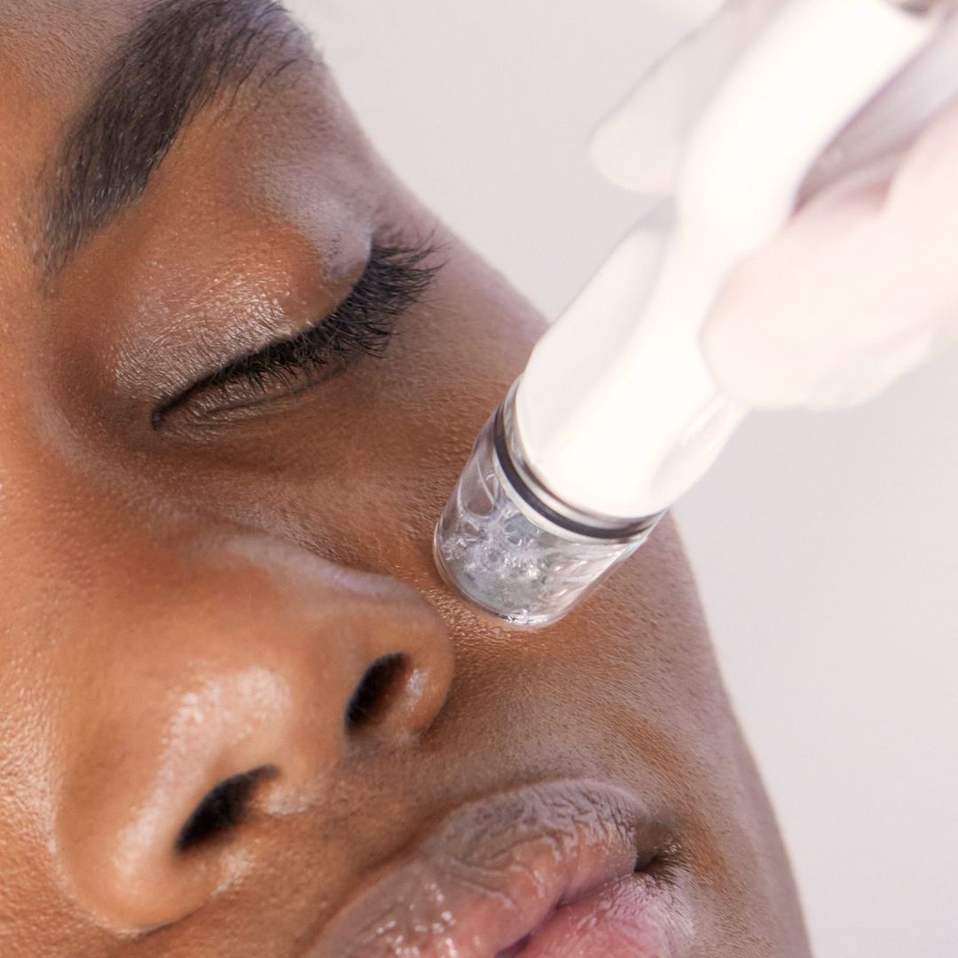 Microneedling