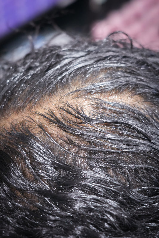 Traitement Chute de Cheveux